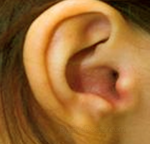 Viêm ống tai ngoài - Biểu hiện & Điều trị